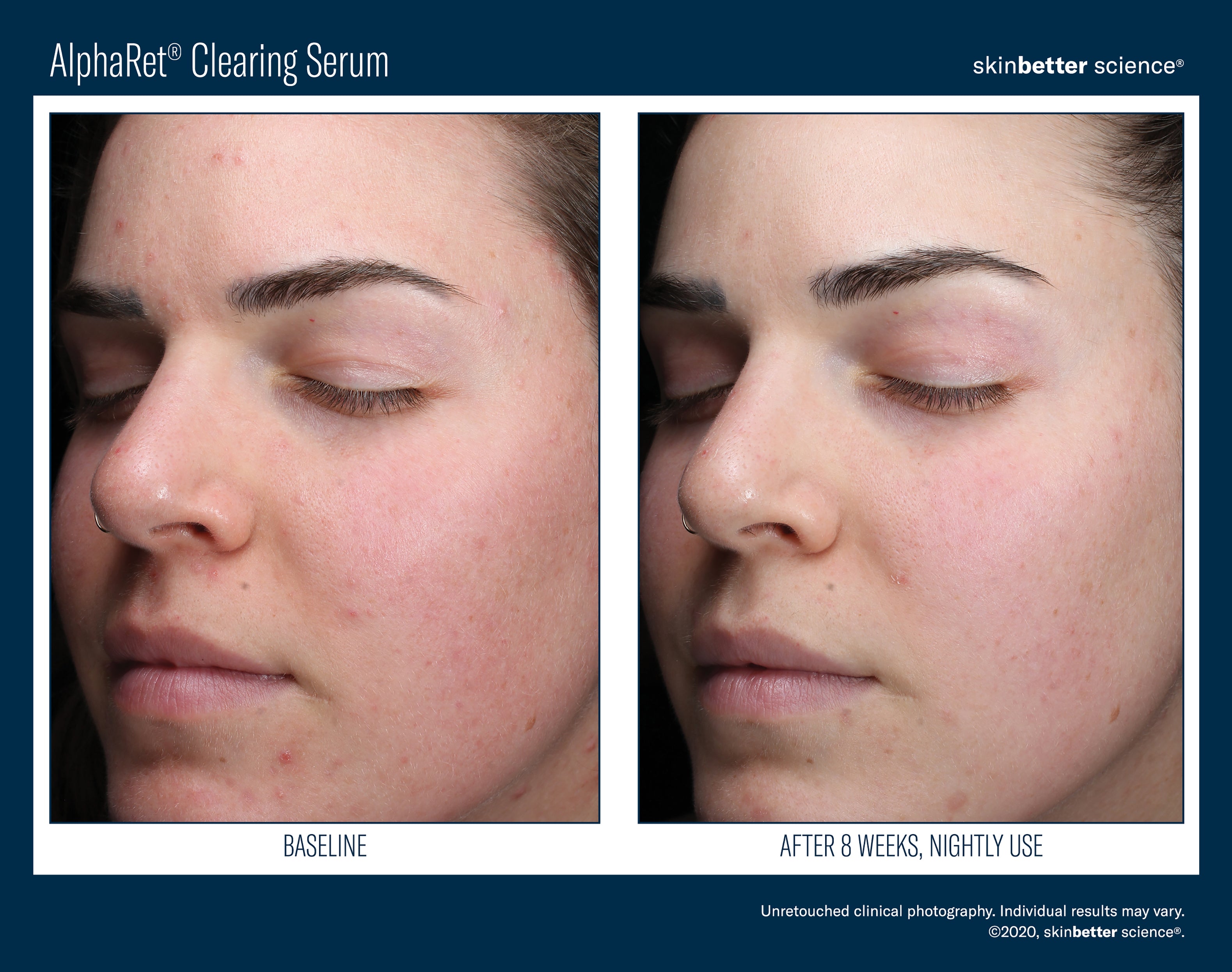 SkinBetter Science AlphaRet Clearing Serum (1.7 oz).