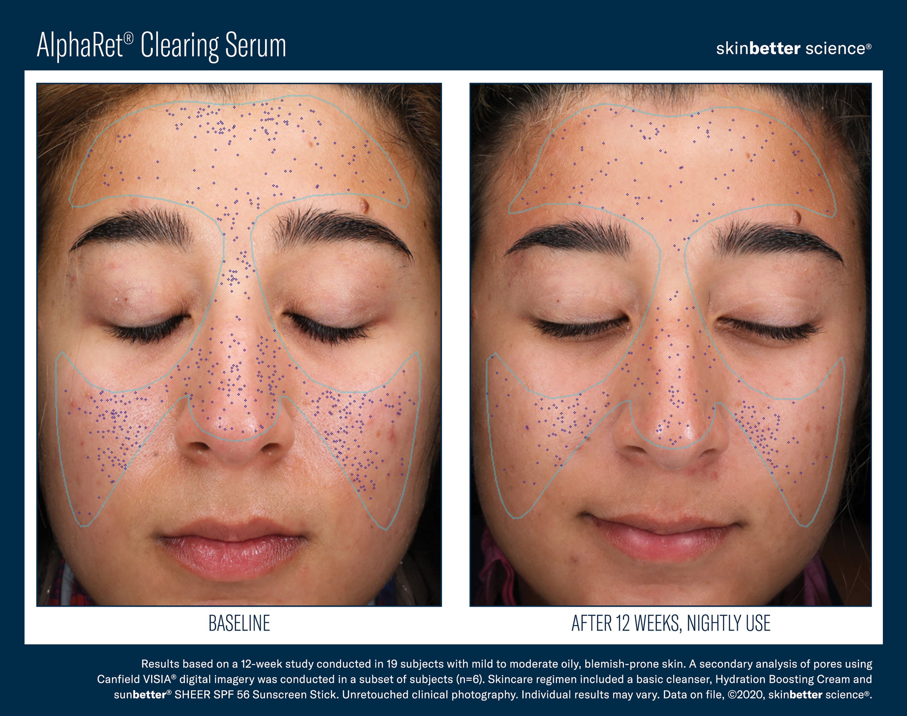 SkinBetter Science AlphaRet Clearing Serum (1.7 oz).