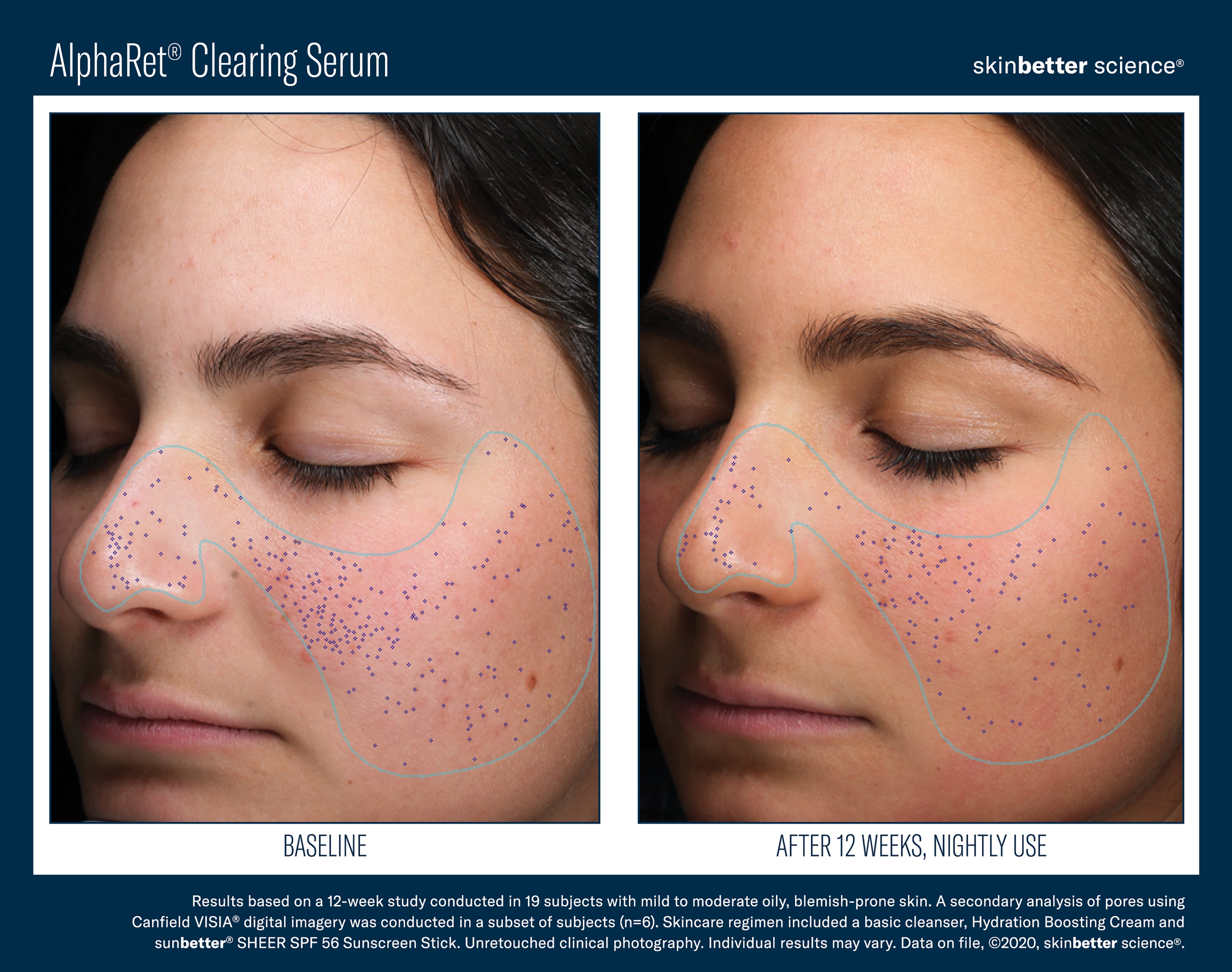 SkinBetter Science AlphaRet Clearing Serum (1 oz)