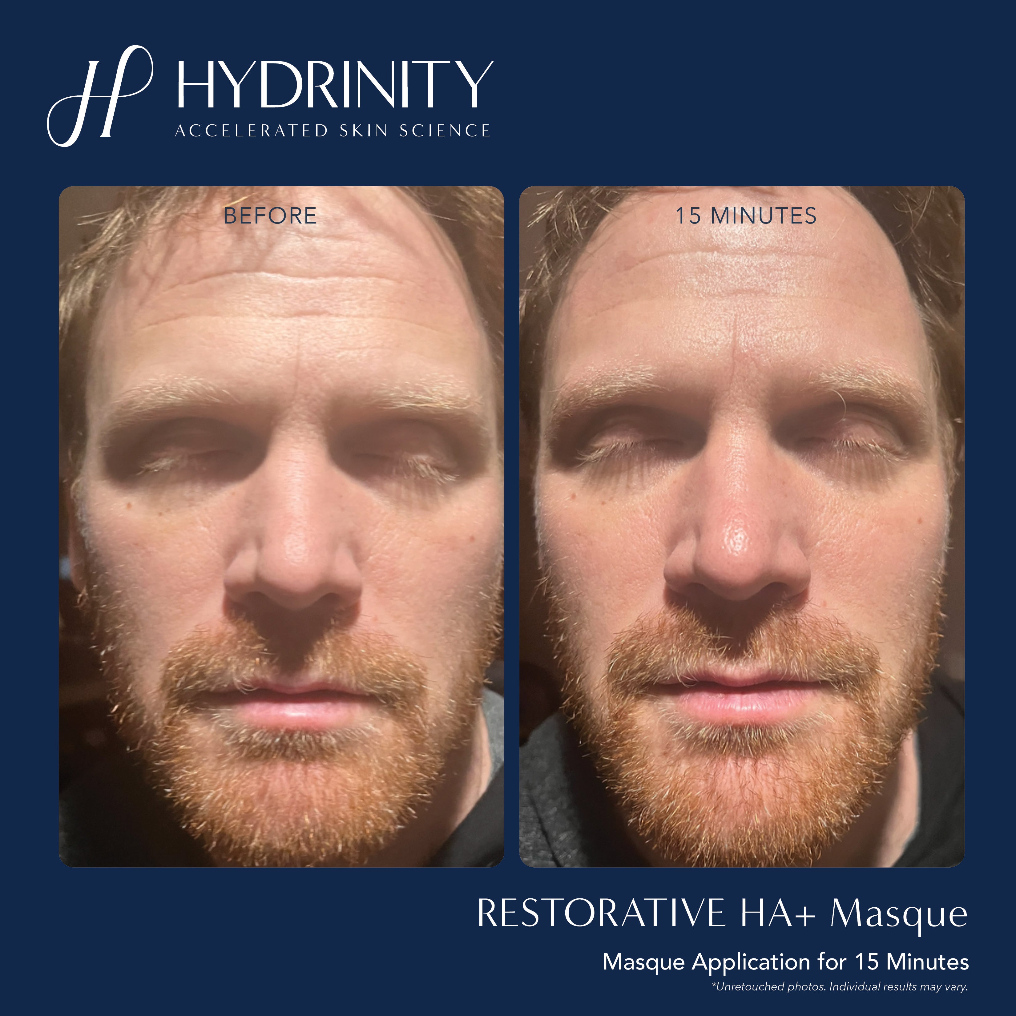 Hydrinity Restorative HA+ Masque (5 Count)