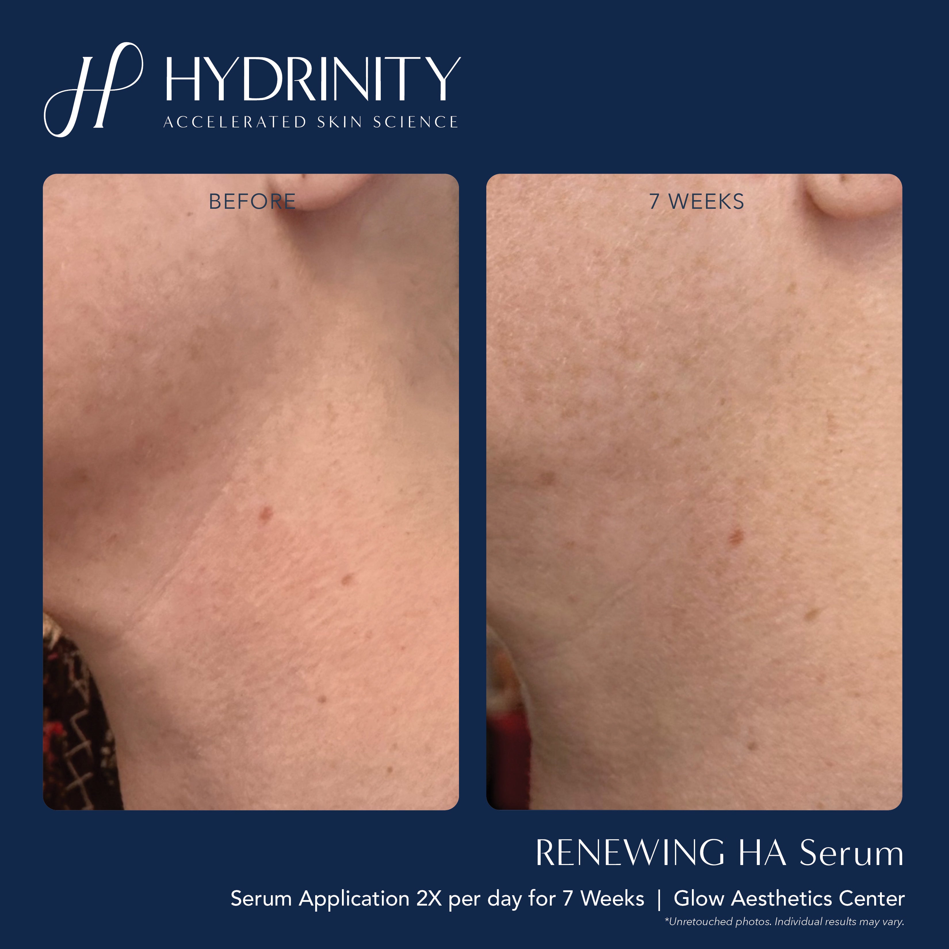 Hydrinity Renewing HA Serum (1 oz)