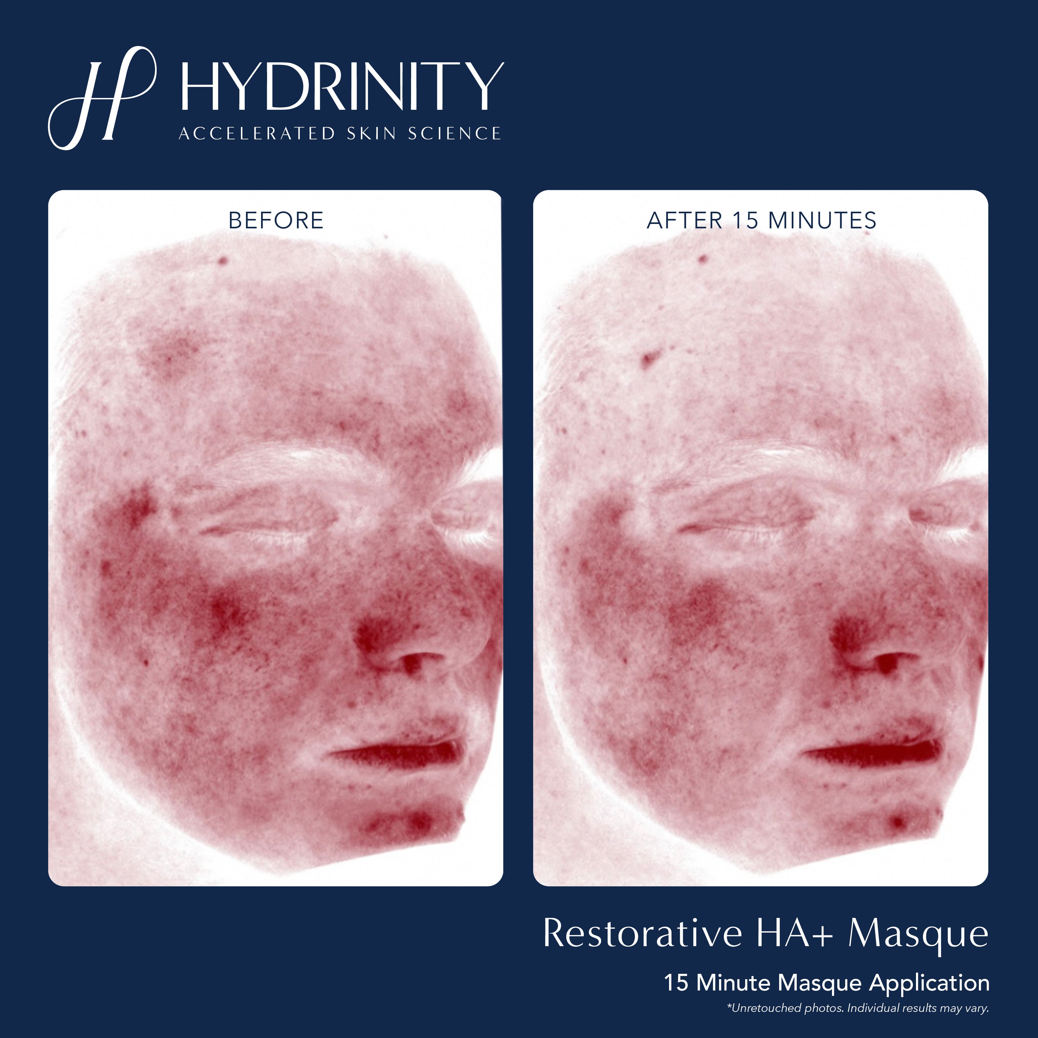 Hydrinity Restorative HA+ Masque (5 Count)