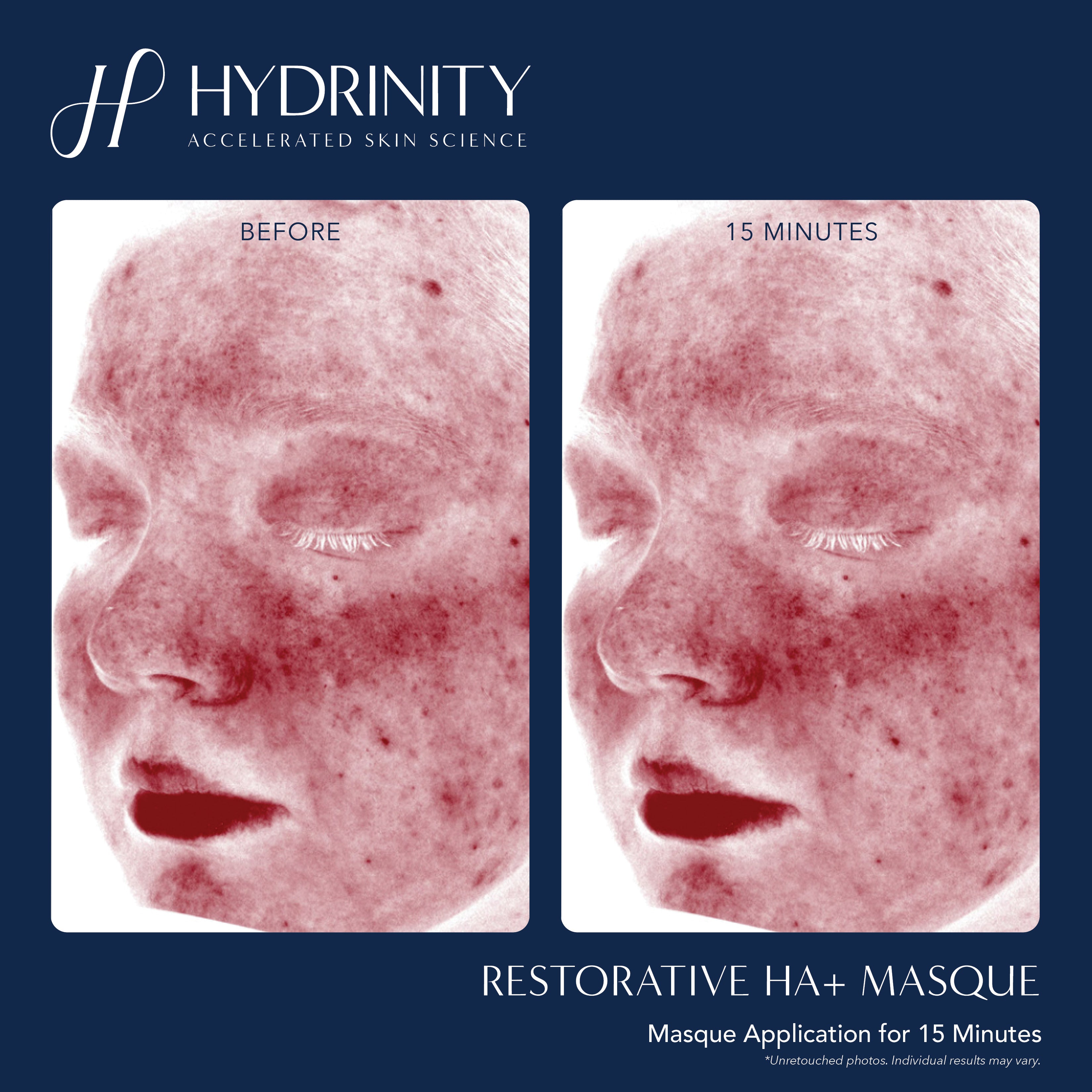Hydrinity Restorative HA+ Masque (5 Count)