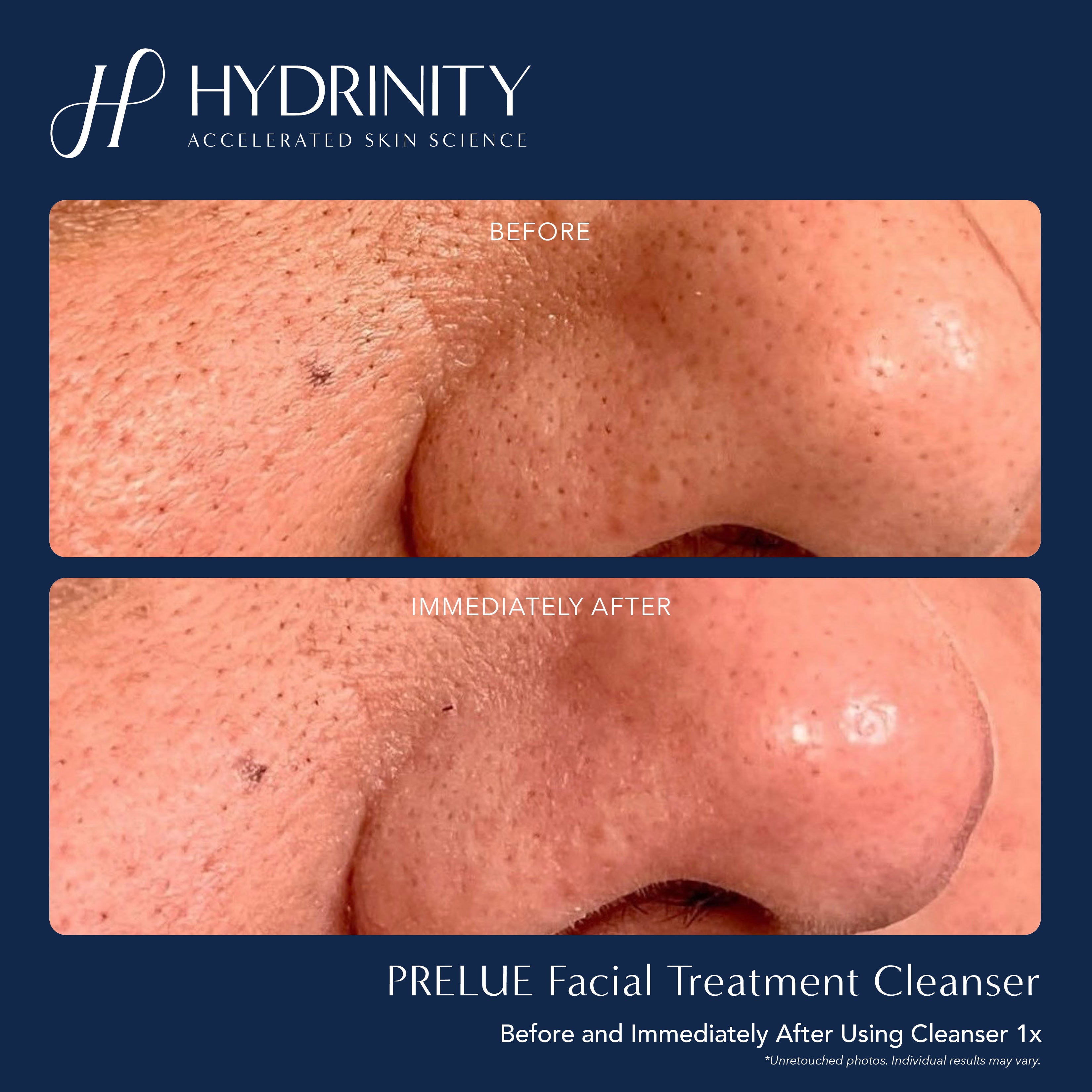 Hydrinity PRELUDE Facial Treatment Cleanser (6 oz)