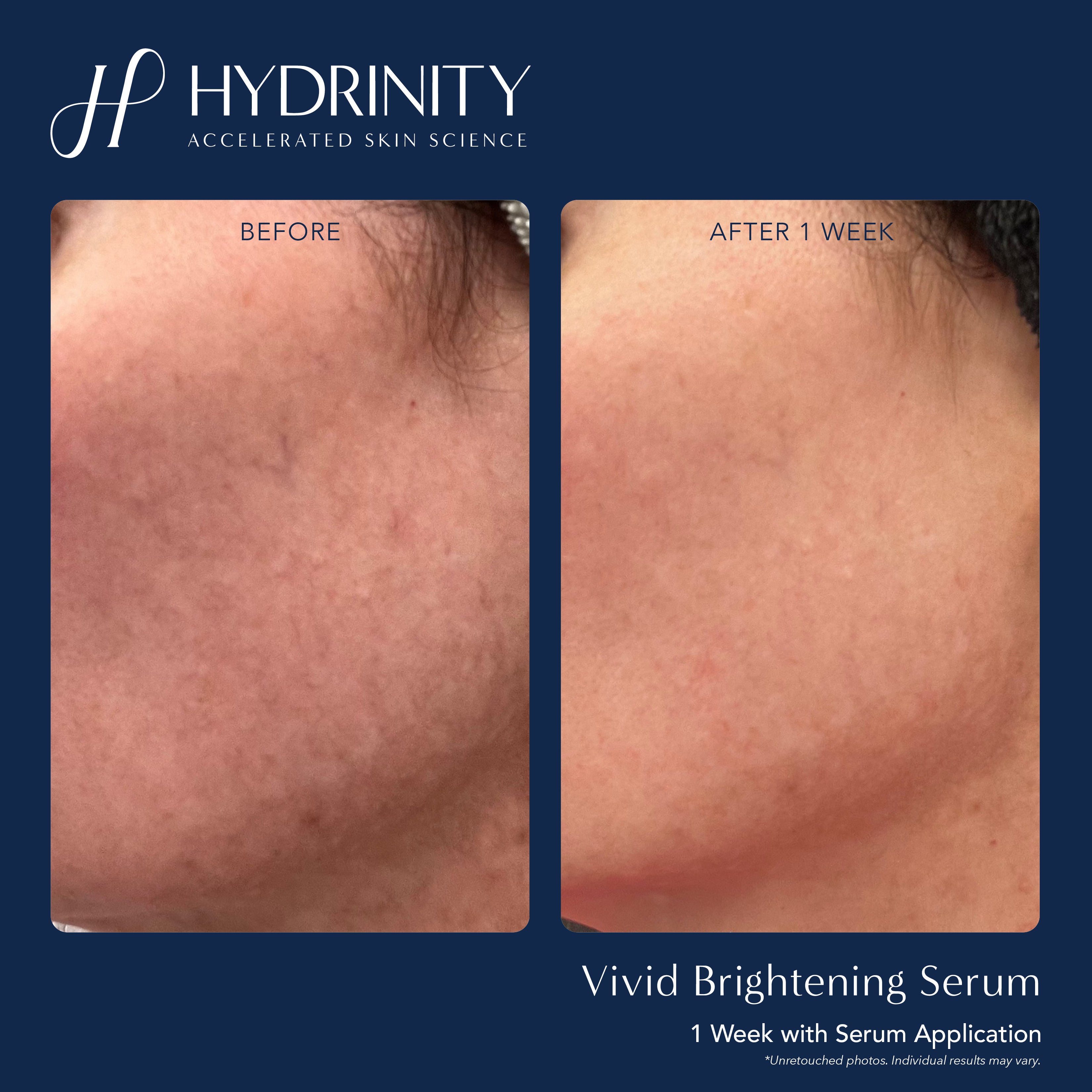 Hydrinity VIVID Brightening Serum (1 oz)