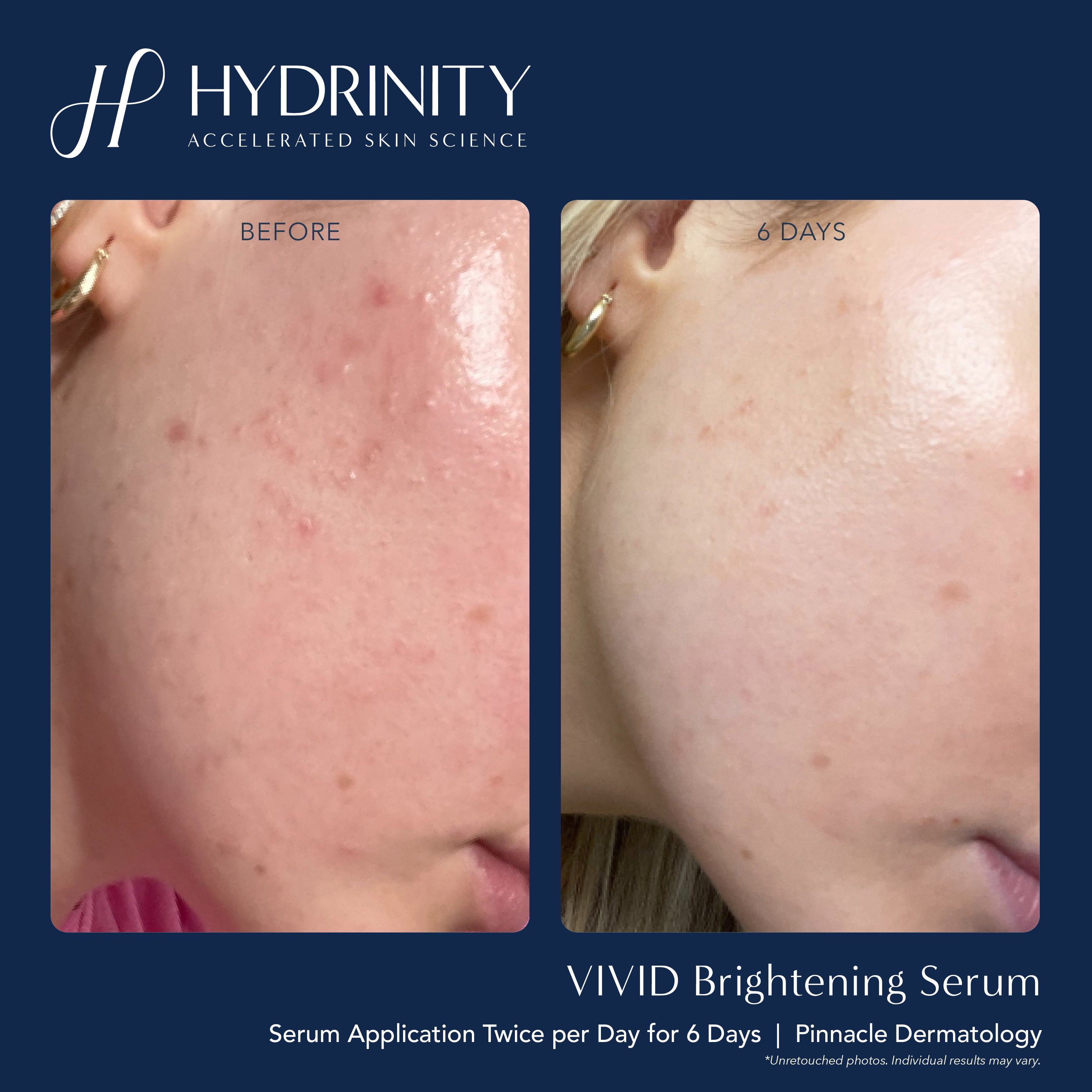 Hydrinity VIVID Brightening Serum (1 oz)