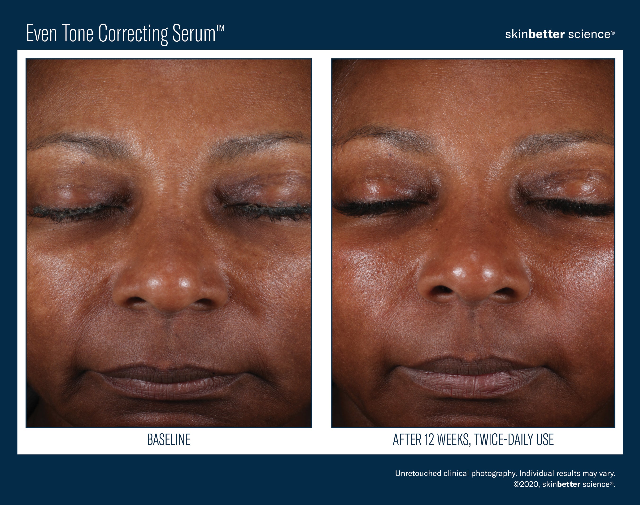 SkinBetter Science Even Tone Correcting Serum (1.69 oz)