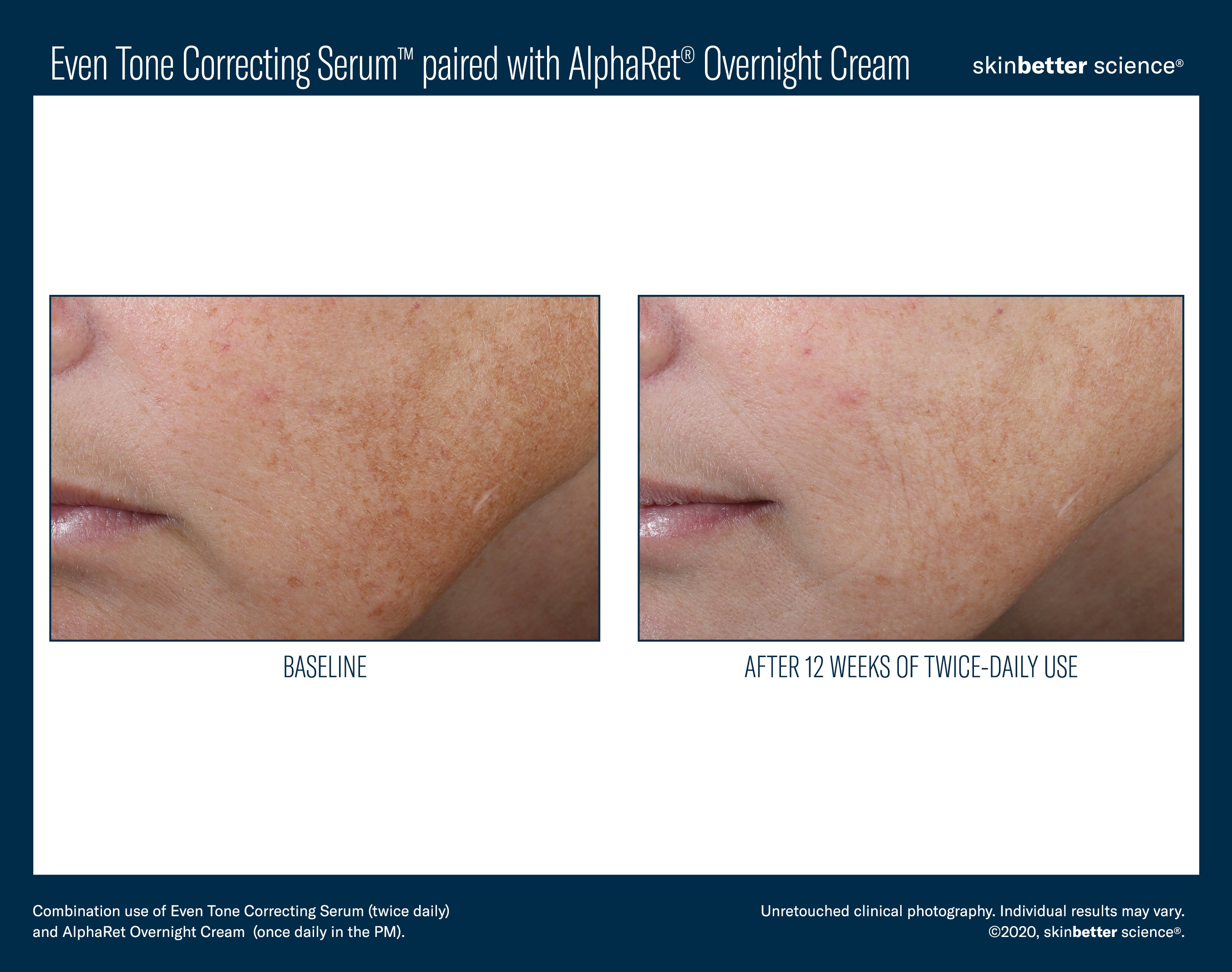 SkinBetter Science Even Tone Correcting Serum (1.69 oz)