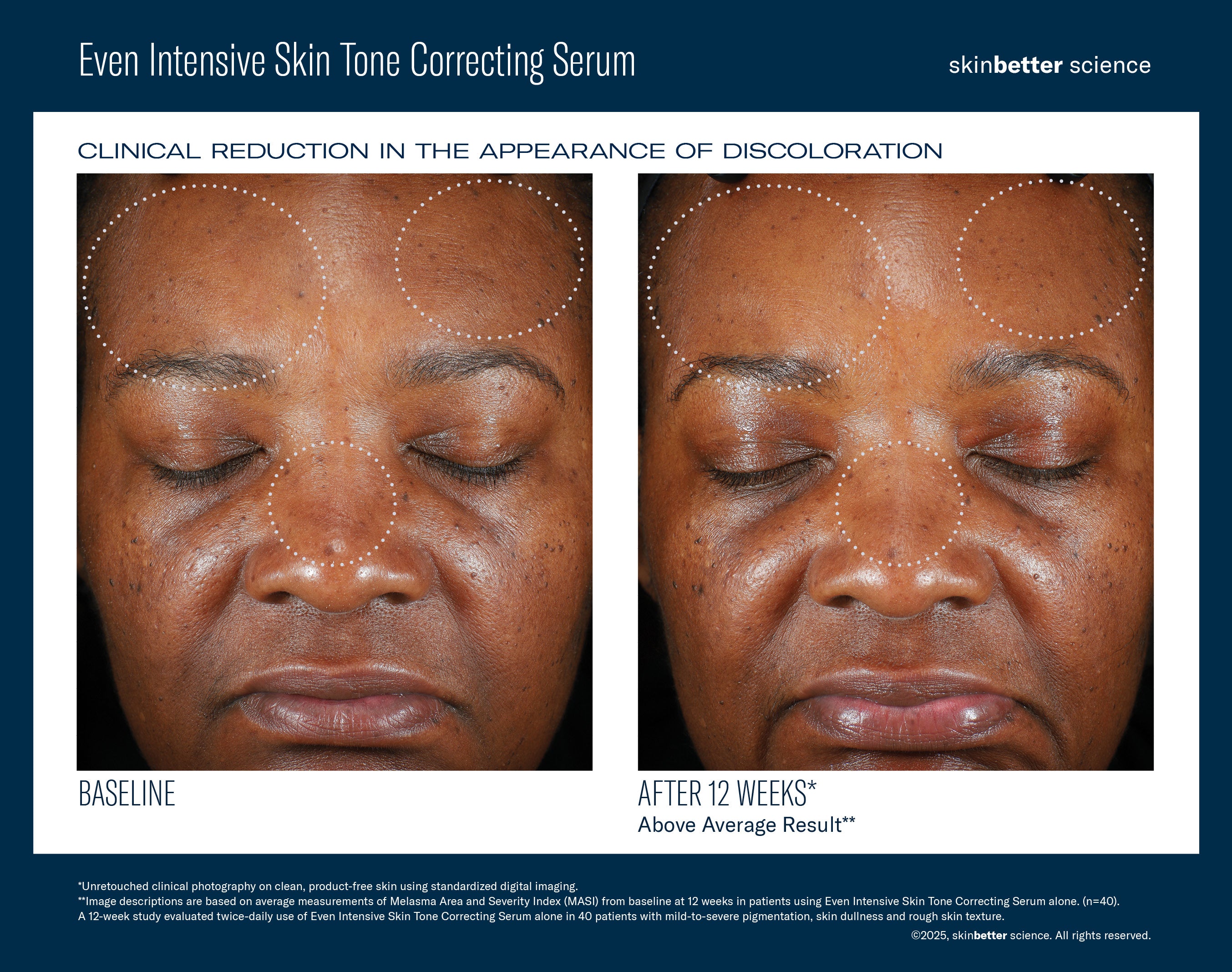 SkinBetter Science Even Intensive Skin Tone Correcting Serum (1.7 oz)