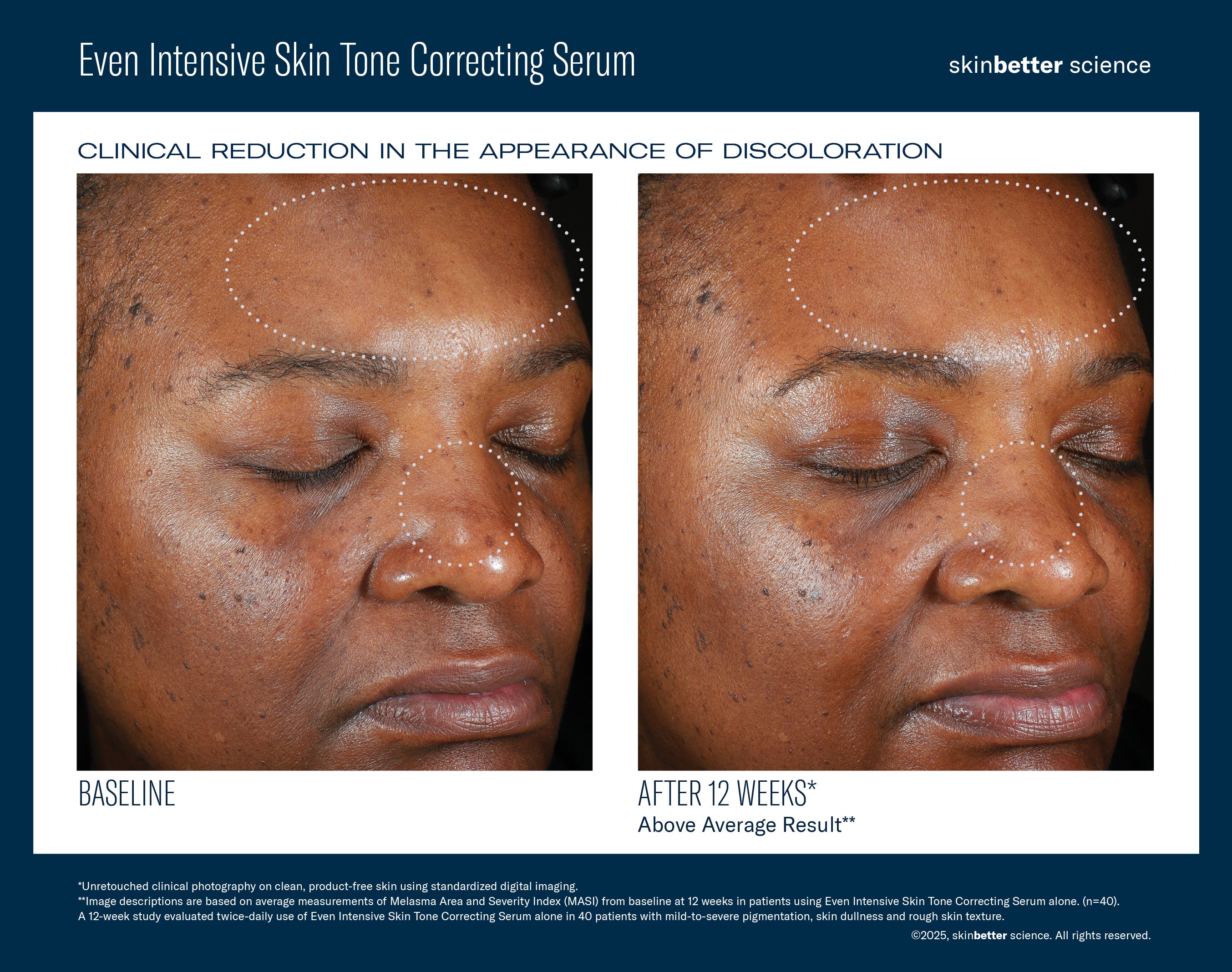 SkinBetter Science Even Intensive Skin Tone Correcting Serum (1.7 oz)