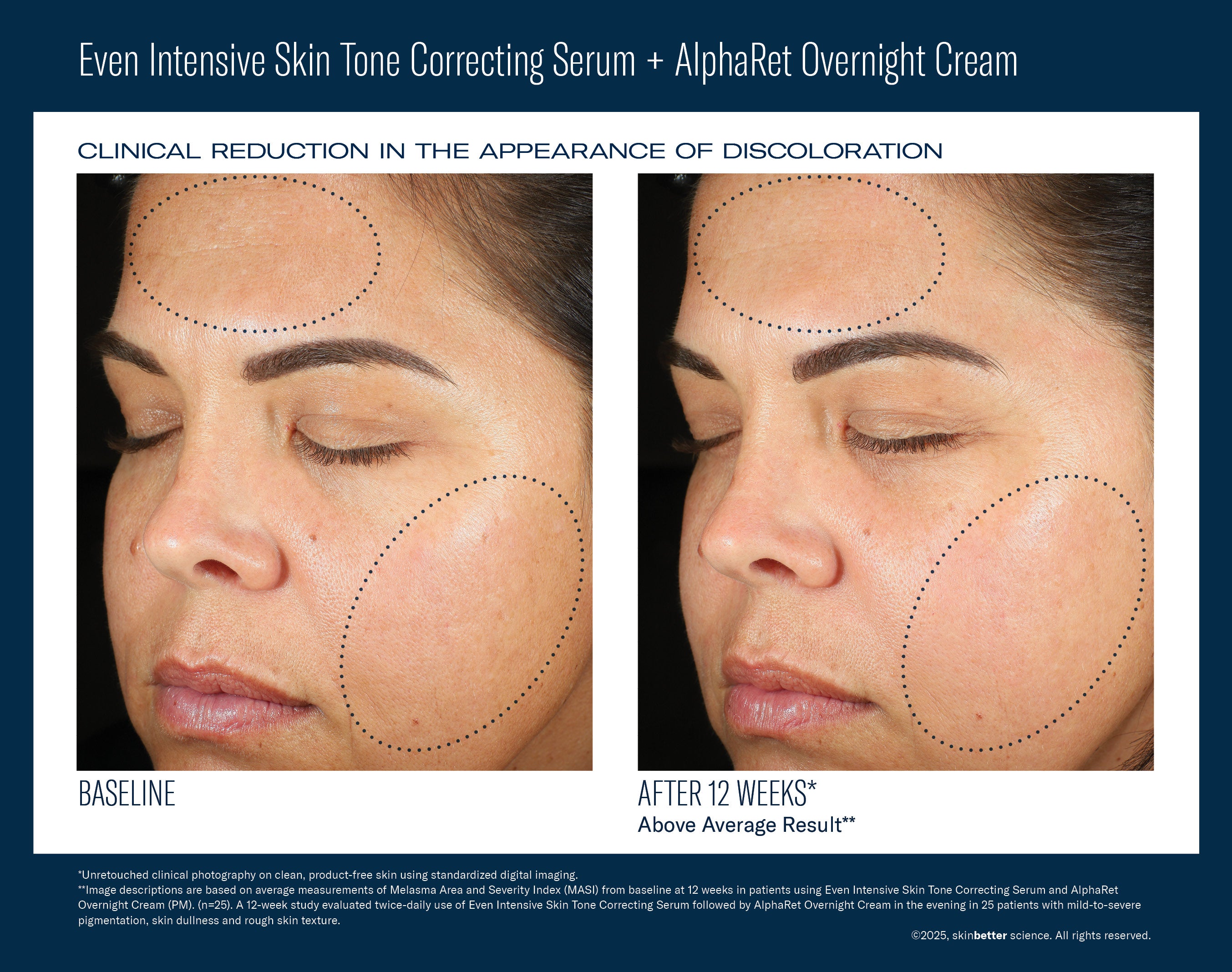 SkinBetter Science Even Intensive Skin Tone Correcting Serum (1.7 oz)