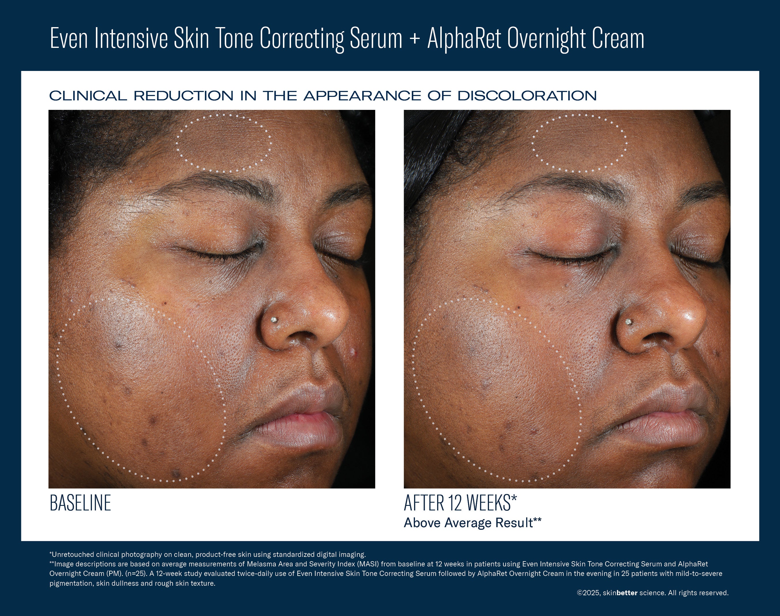 SkinBetter Science Even Intensive Skin Tone Correcting Serum (1.7 oz)