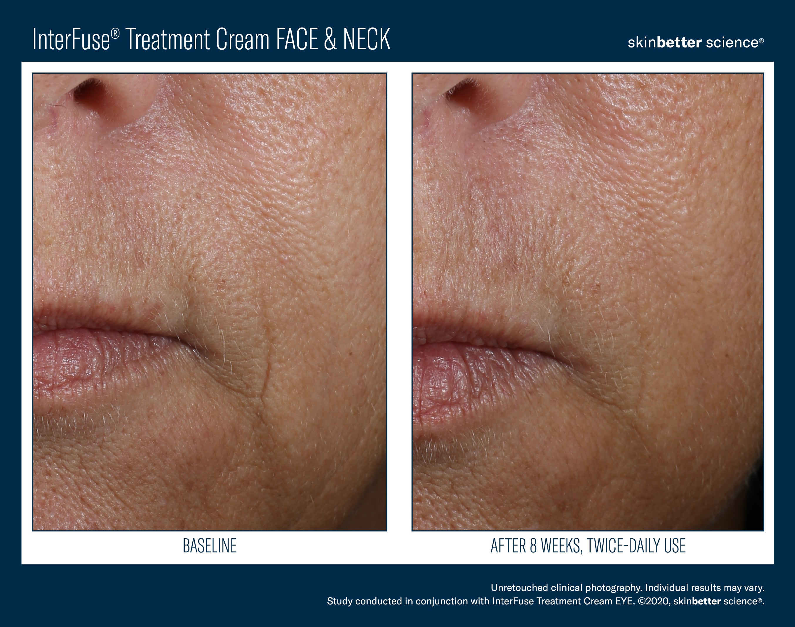 SkinBetter Science Travel Size InterFuse Treatment Cream Face & Neck (0.17 oz)