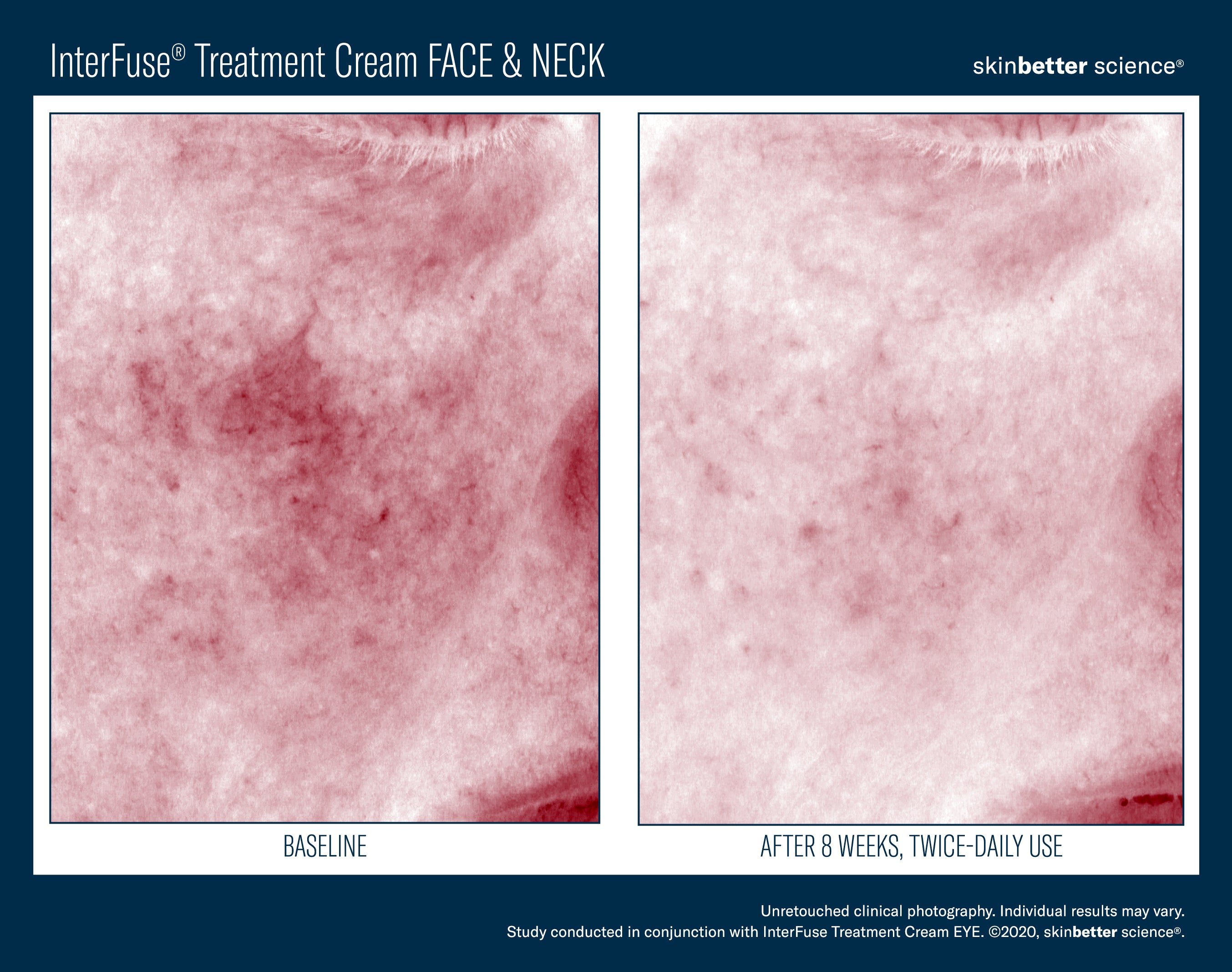 SkinBetter Science Travel Size InterFuse Treatment Cream Face & Neck (0.17 oz)