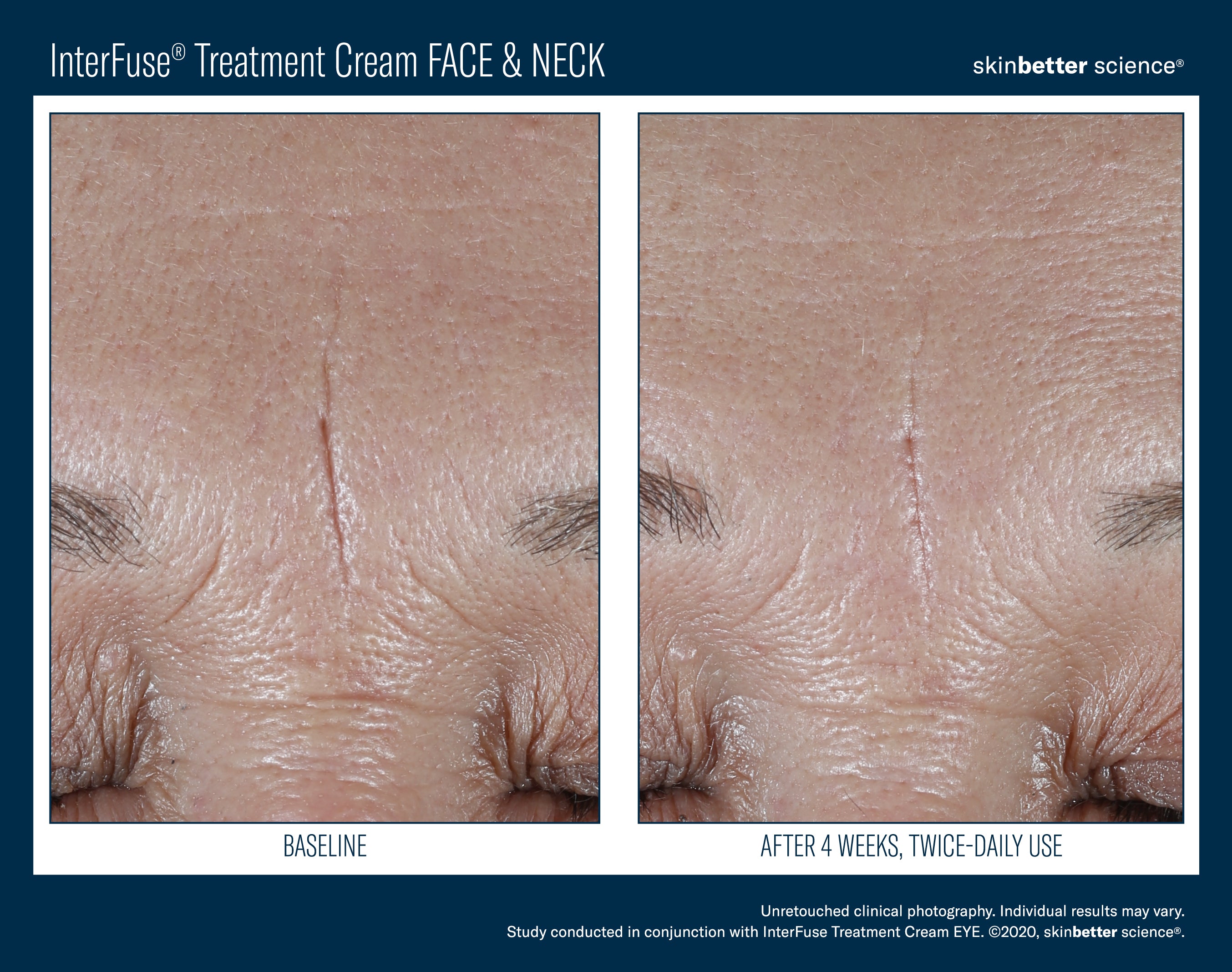 SkinBetter Science Travel Size InterFuse Treatment Cream Face & Neck (0.17 oz)