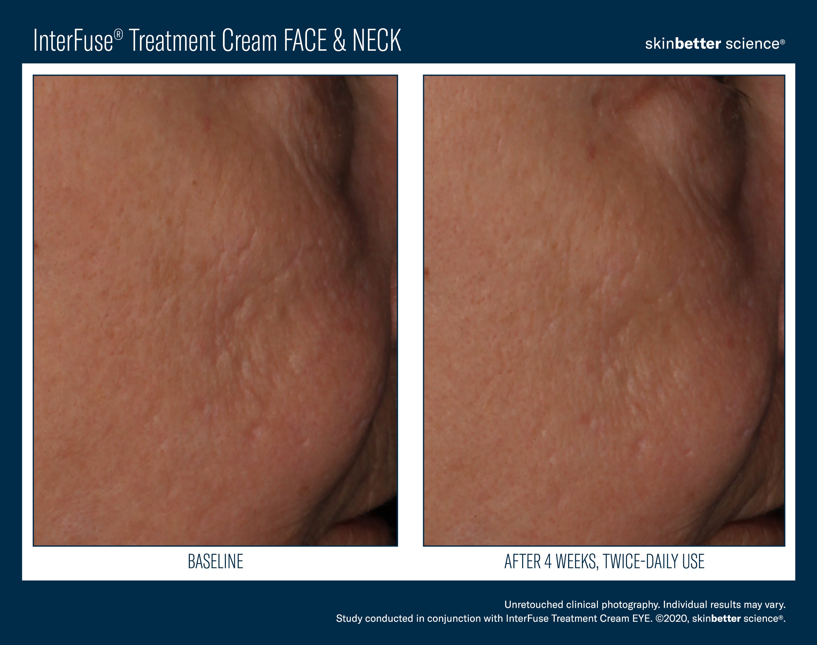 SkinBetter Science Travel Size InterFuse Treatment Cream Face & Neck (0.17 oz)