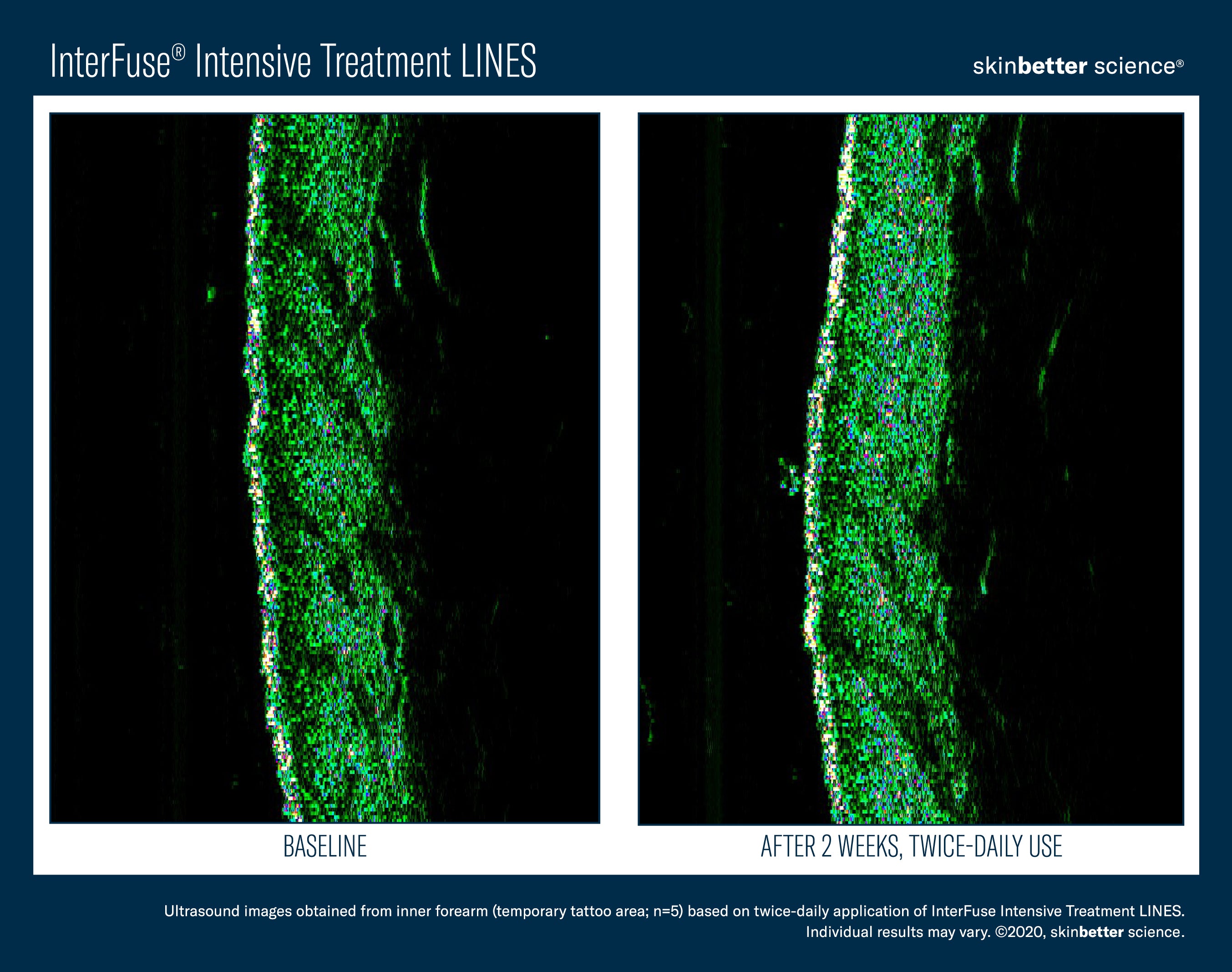 SkinBetter Science InterFuse Intensive Treatment Lines (0.5 oz)