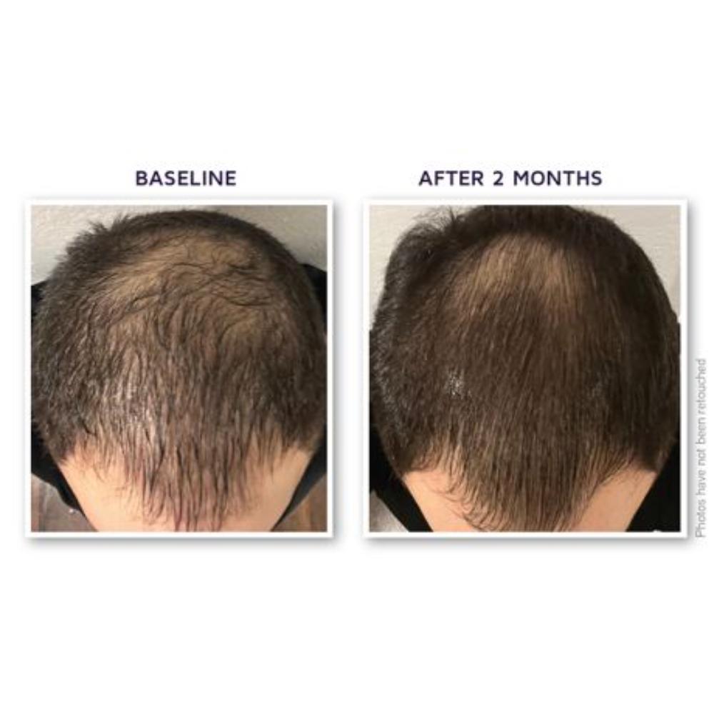DefenAge 150K Hair Follicle Serum - Men's Edition | 1 Month Supply (1 oz)