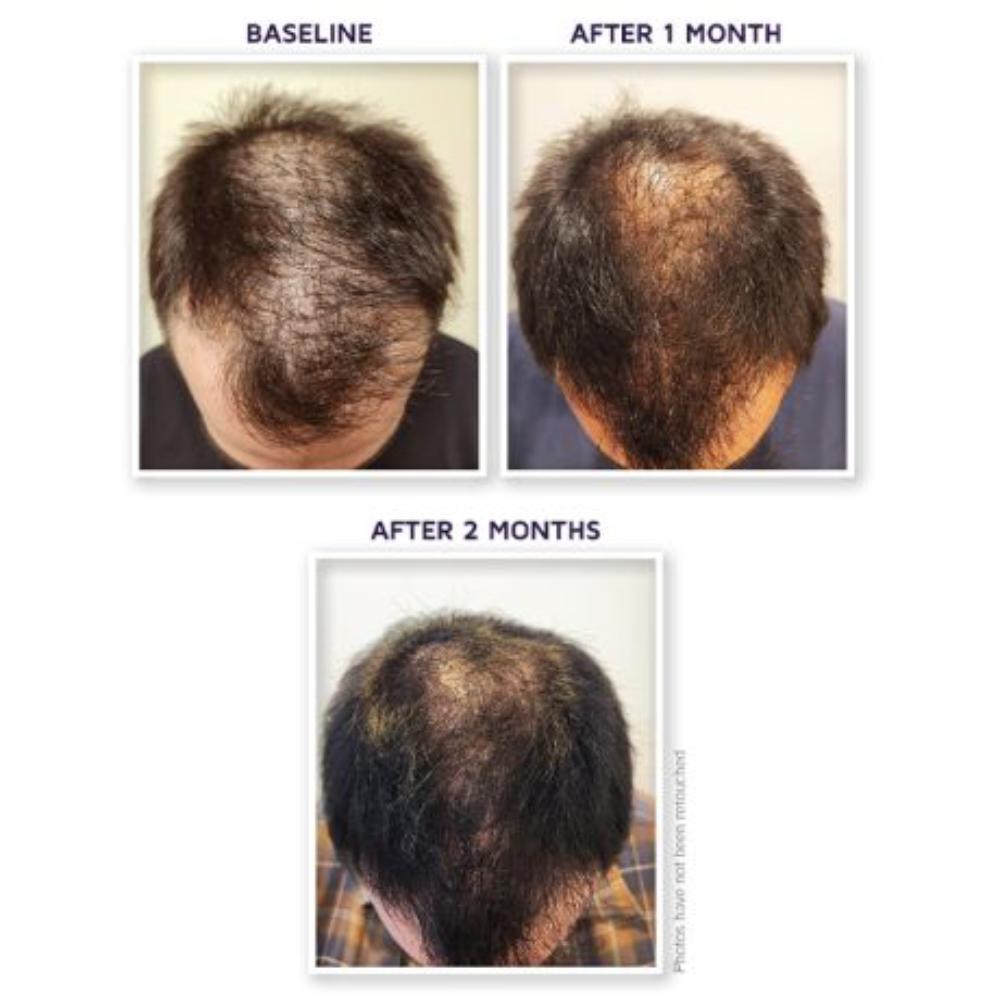 DefenAge 150K Hair Follicle Serum - Men's Edition | 1 Month Supply (1 oz)